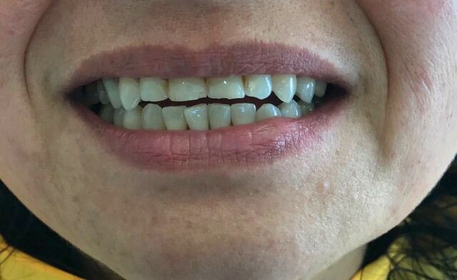 CEREC 1 SESIÓN antes