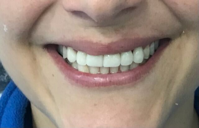 CEREC 1 SESIÓN después