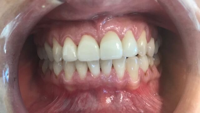 CEREC 1 SESIÓN después