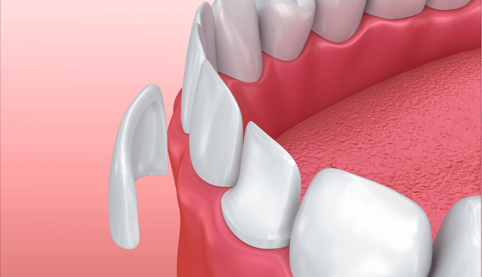 Corona dental. ¿Qué es y cómo funcionan?