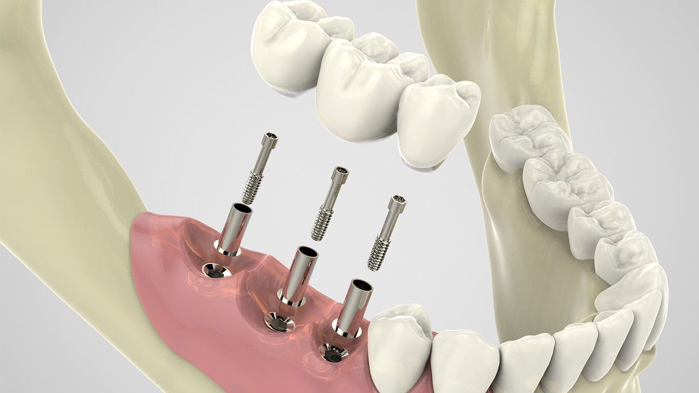 Implantes